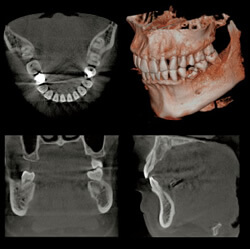 歯科用「3DパノラマCT撮影装置」