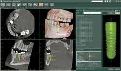 歯科用CTと治療における役割