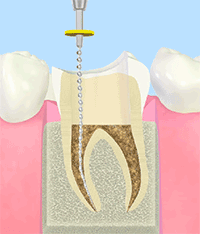 根管治療