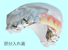 金属床義歯 部分入れ歯