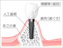 インプラント治療