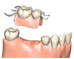 部分入れ歯について