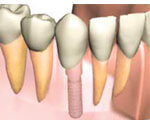 インプラント治療について
