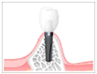 インプラントについて